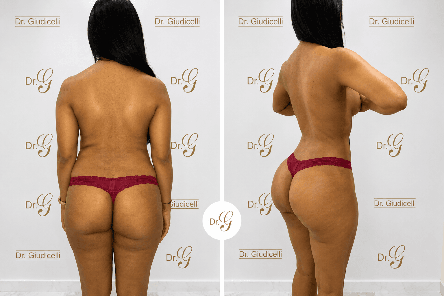 Brazilian butt lift (BBL) result, rear and side views