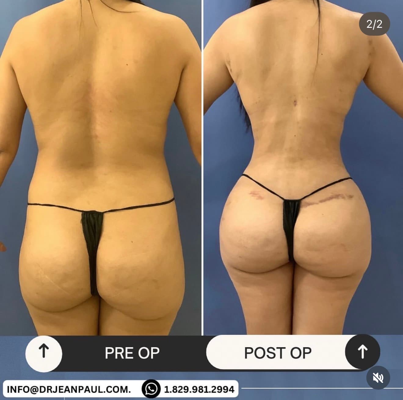 Brazilian butt lift (BBL) before and after, back view