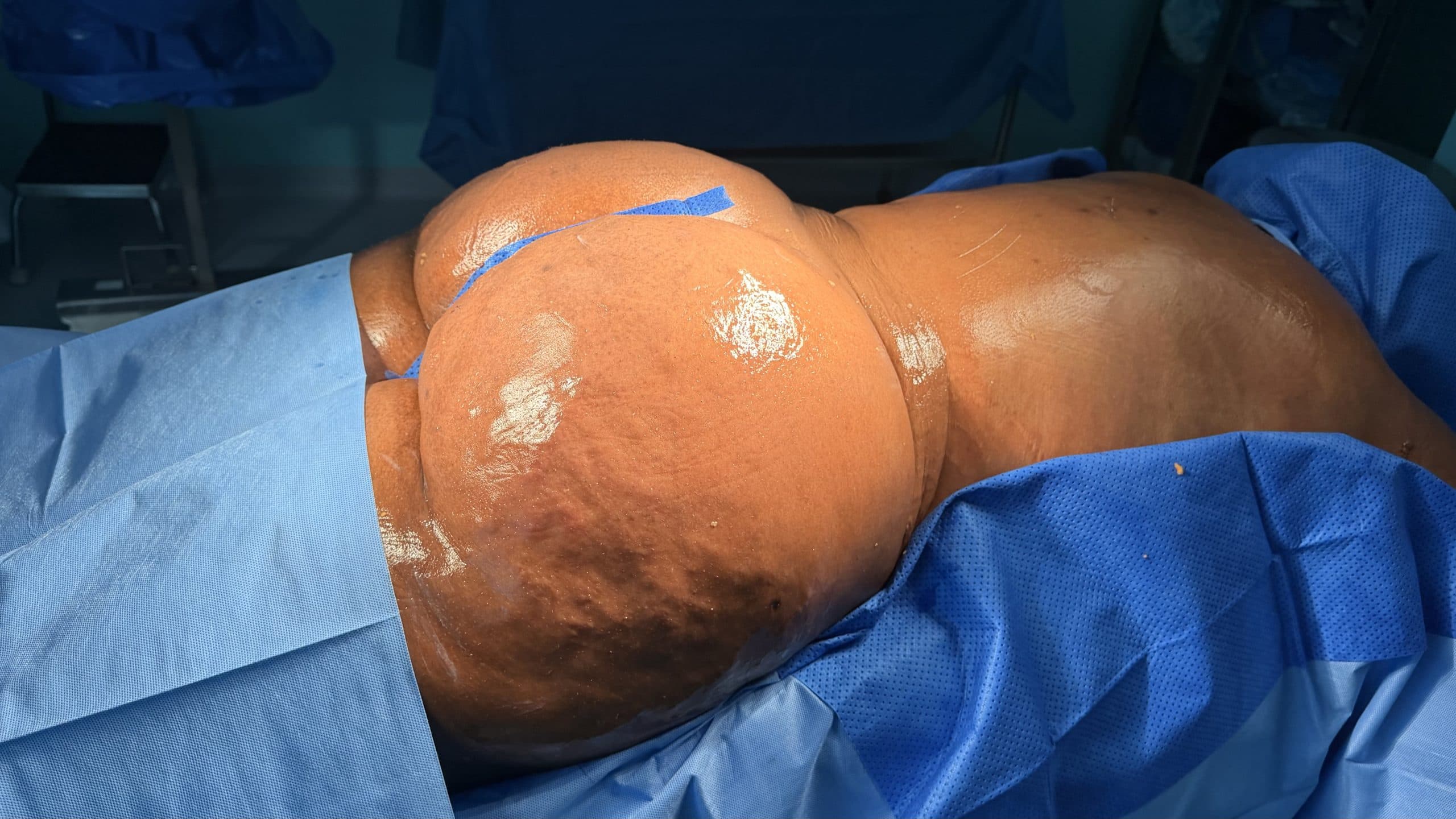 Waist and buttocks immediately after Lipo 360 in the operating room