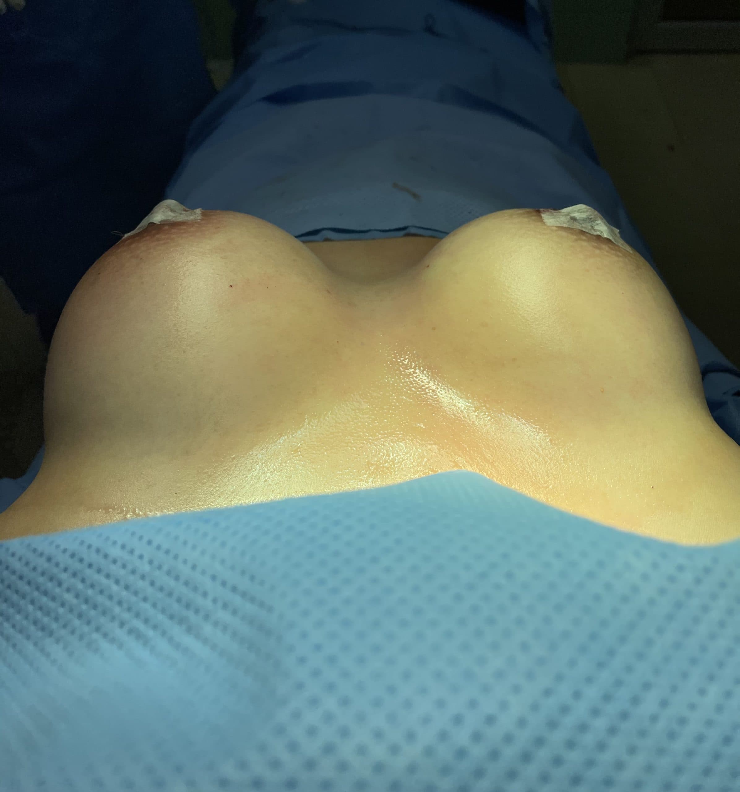 Breast augmentation result immediately after surgery in the operating room