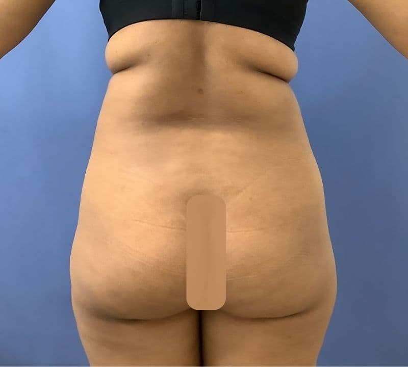 Liposculpture and BBL candidate before surgery, back view
